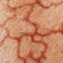 Varice varicoza reticulare 