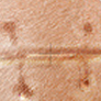 Tratamentul cicatricelor