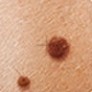 Preventia cancerelor de piele 