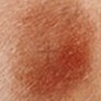Chirurgie controlata Micrografic