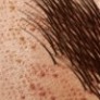 Epilare definitiva cu Laser