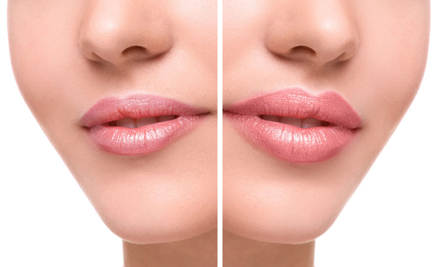 Lips  before and after augmentation